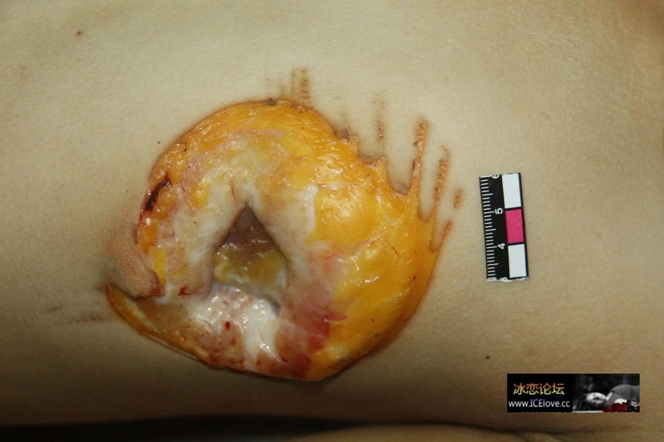 гнойные раны на груди у женщин фото 61