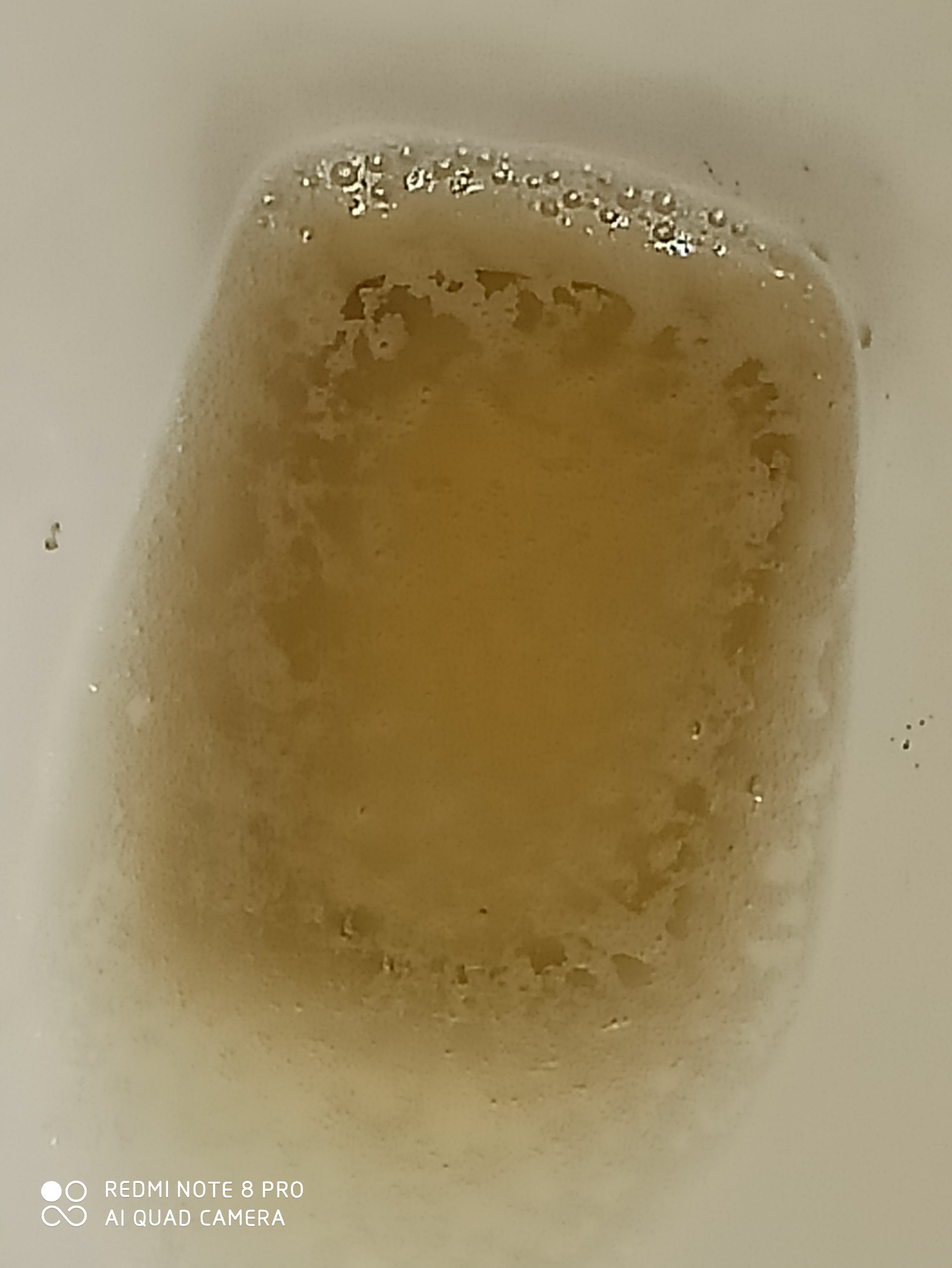 I have had bubbles in urine for four consecutive months, and the
